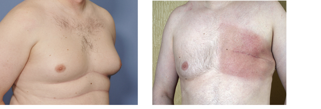 Male Breast Cancer